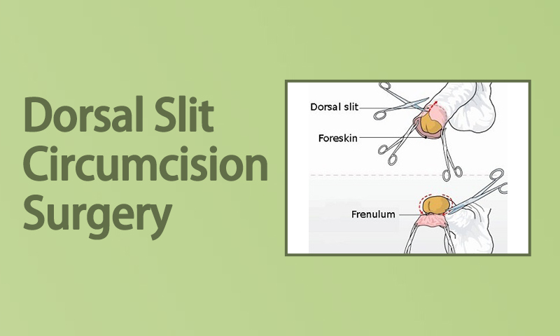 Dorsal Slit Circumcision Surgery