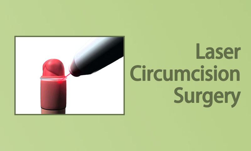 Laser Circumcision Surgery