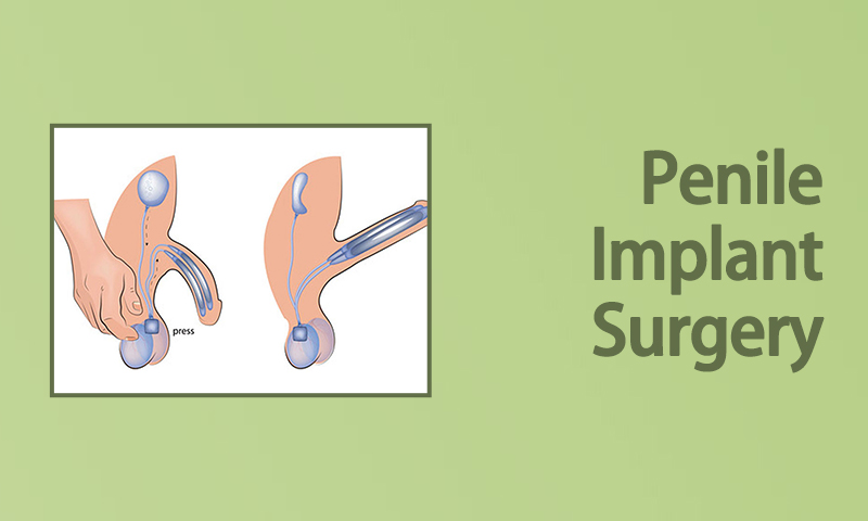 Penile Implant Surgery