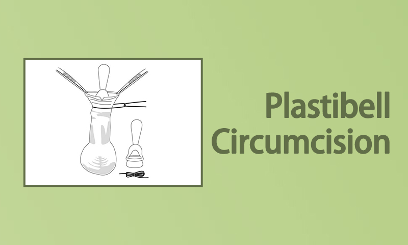 Plastibell Circumcision