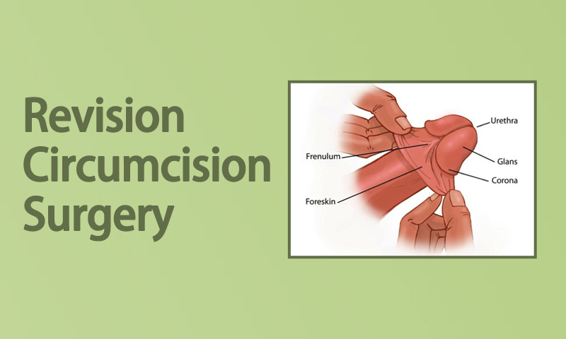 Revision Circumcision Surgery