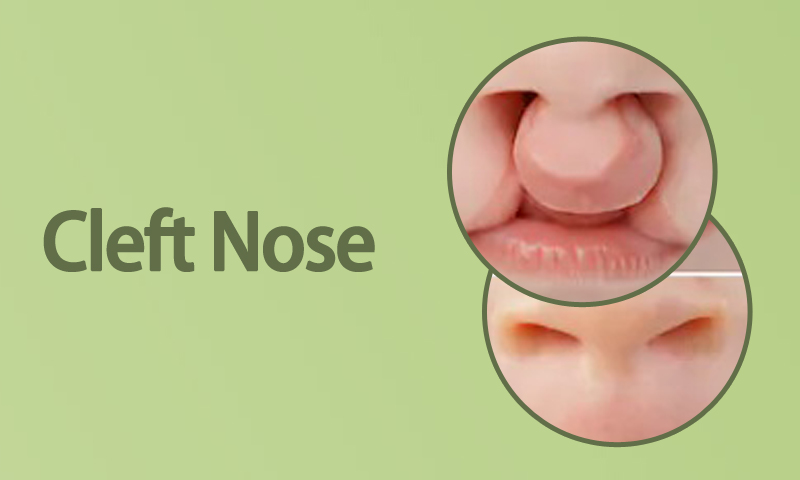 Cleft Nose