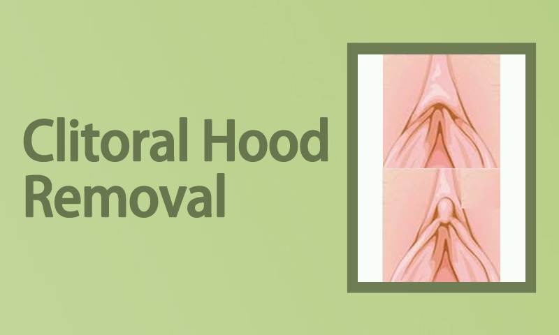 Clitoral Hood Removal Surgery in Surat, Gujarat (India)