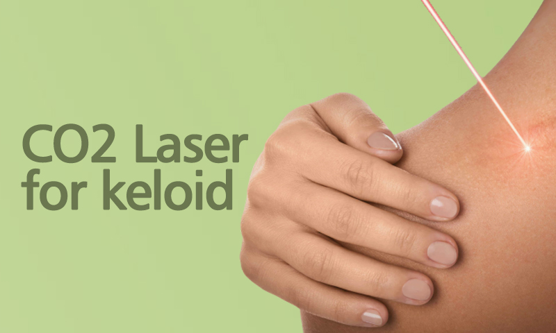 CO2 Laser For Keloid