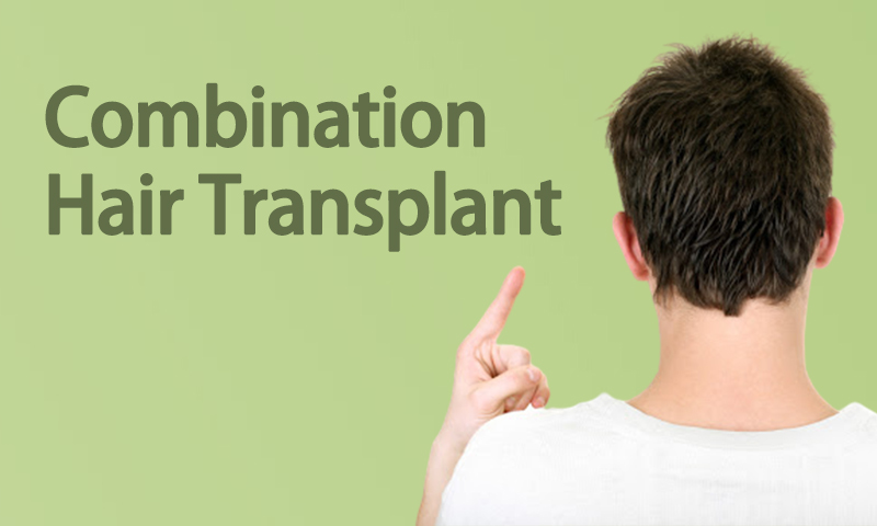 Combination Hair Transplant