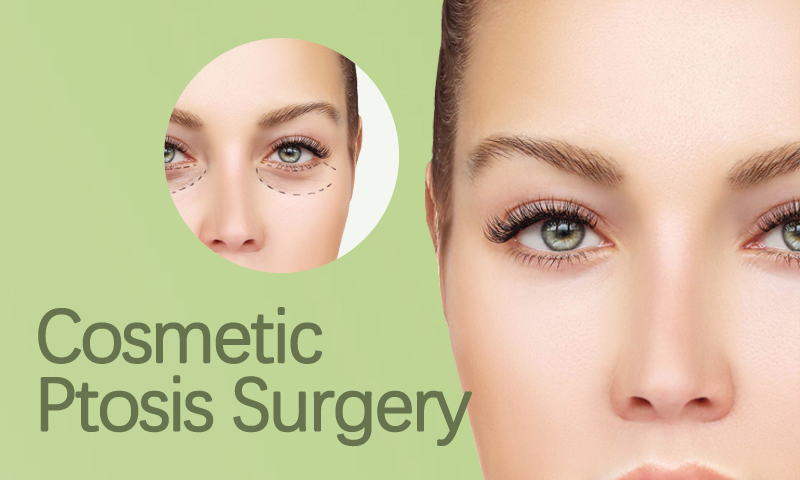 Cosmetic Ptosis Surgery in Surat, Gujarat (India)