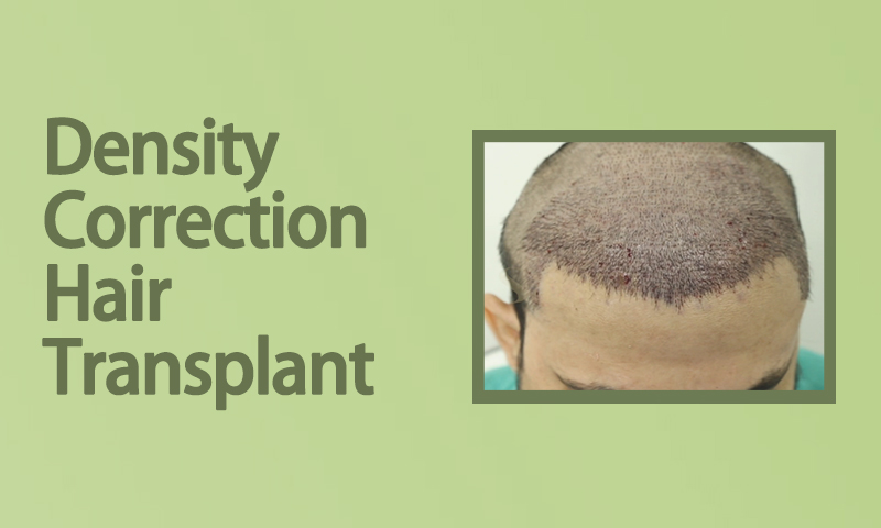 Density Correction Hair Transplant