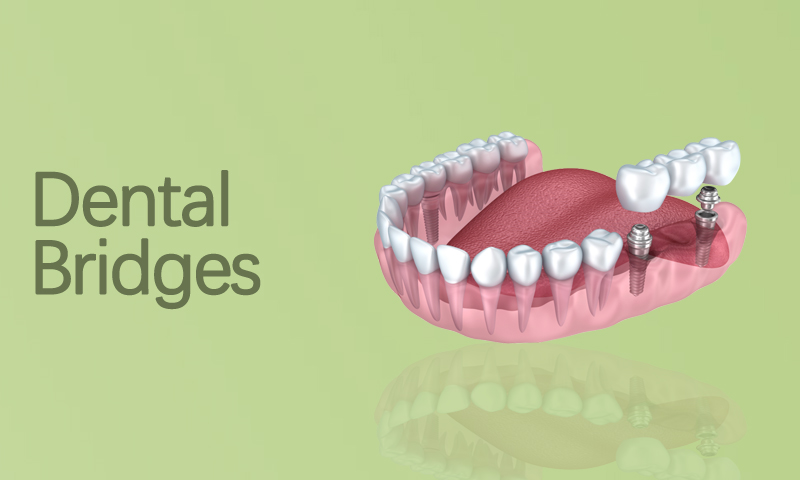 Dental Bridges Treatment in Surat, Gujarat (India)