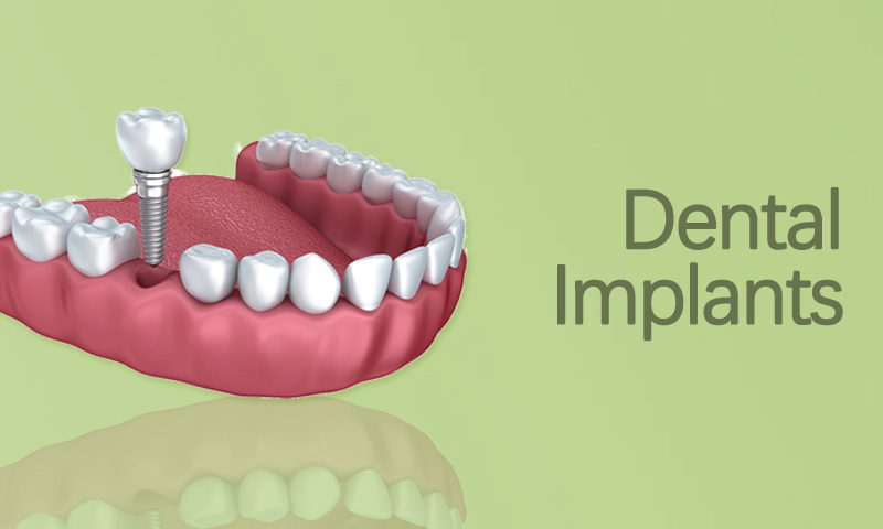 Dental Implants in Surat, Gujarat (India)