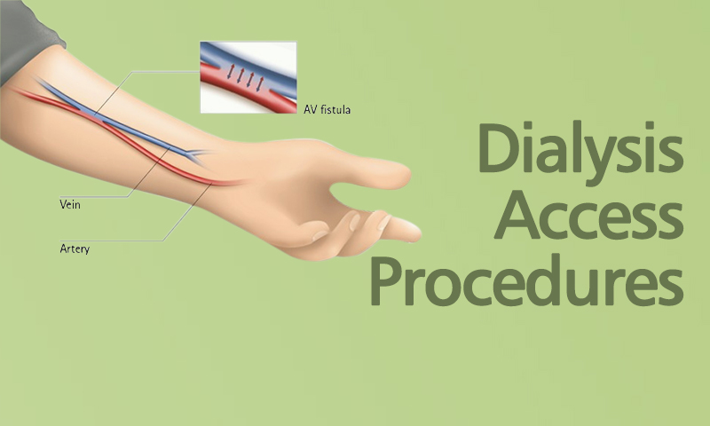 Dialysis Access Procedures