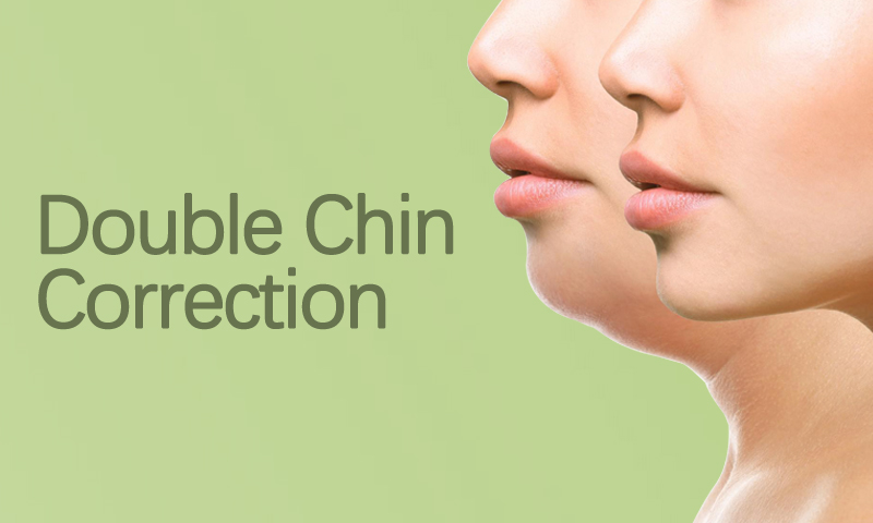 Double Chin Correction in Surat, Gujarat (India)