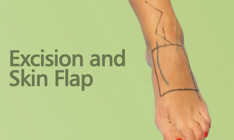 Excision And Skin Flap