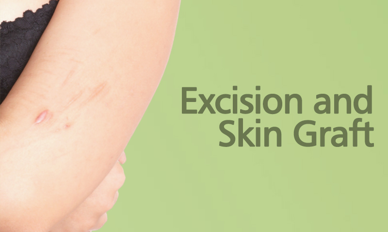 Excision And Skin Graft