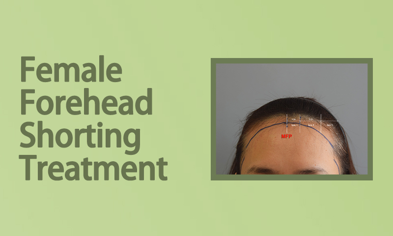 Female Forehead Shorting Treatment