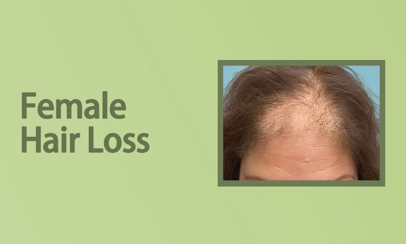 Female Hair Loss