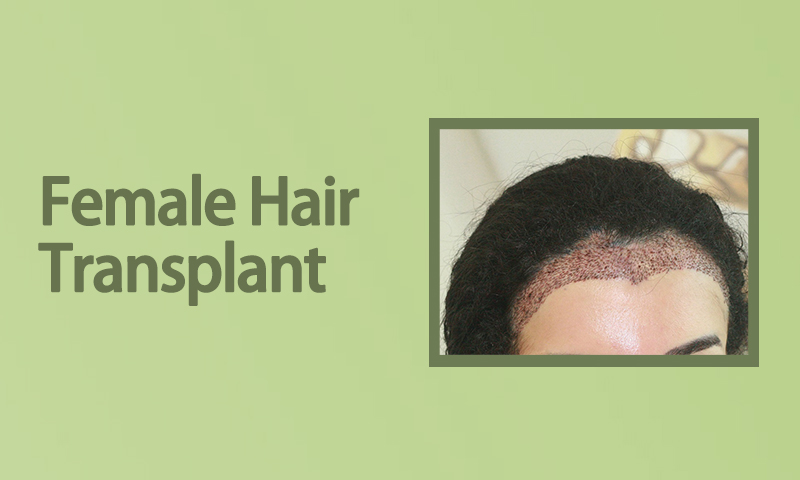 Female Hair Transplant