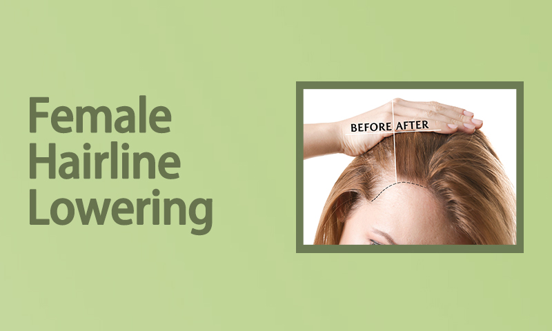 Female Hairline Lowering