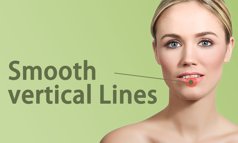 Fillers for Smooth Vertical Lip Lines in Surat, Gujarat (India)