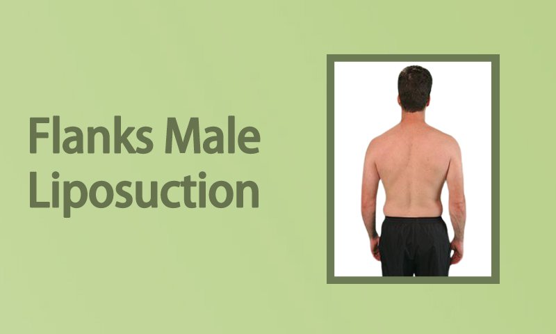 Flanks Male Liposuction