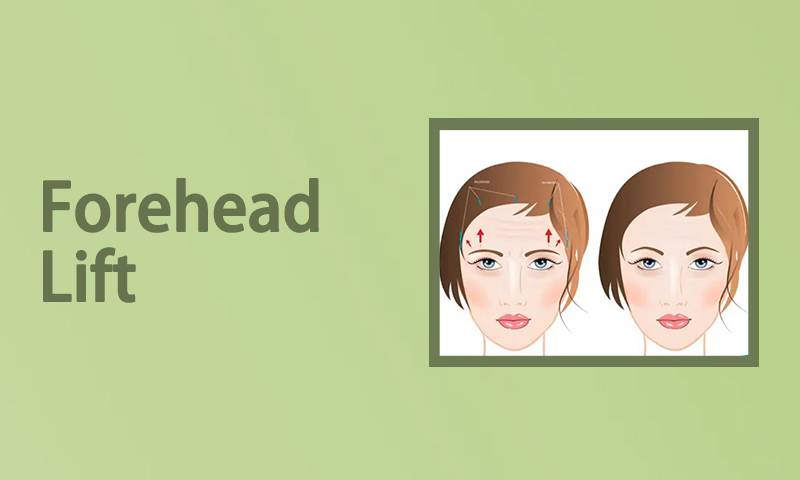 FOREHEAD LIFT