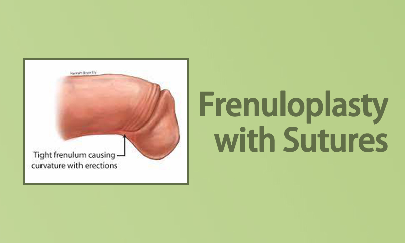Frenuloplasty with Sutures