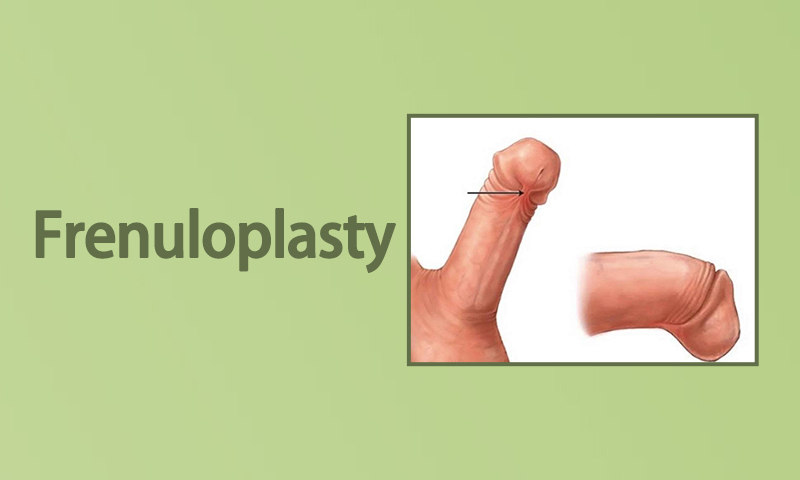 Frenuloplasty