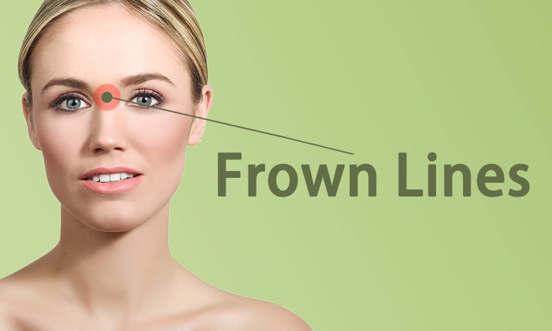 Frown Lines Fillers Treatment in Surat, Gujarat (India)