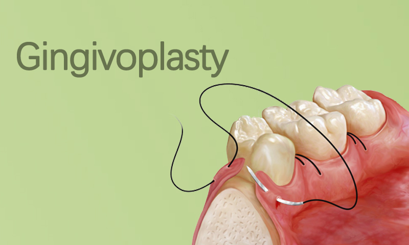 Gingivoplasty in Surat, Gujarat (India)