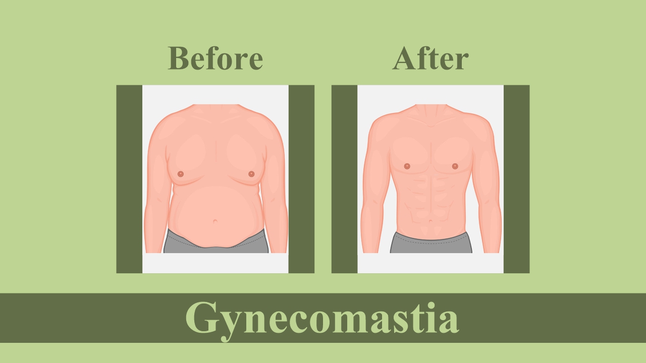 Type 4 Gynecomastia - Moderate Breast Roll