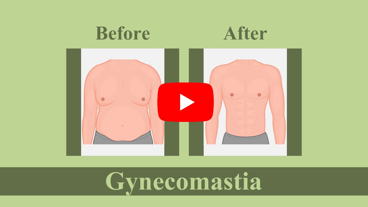 Unilateral Gynecomastia