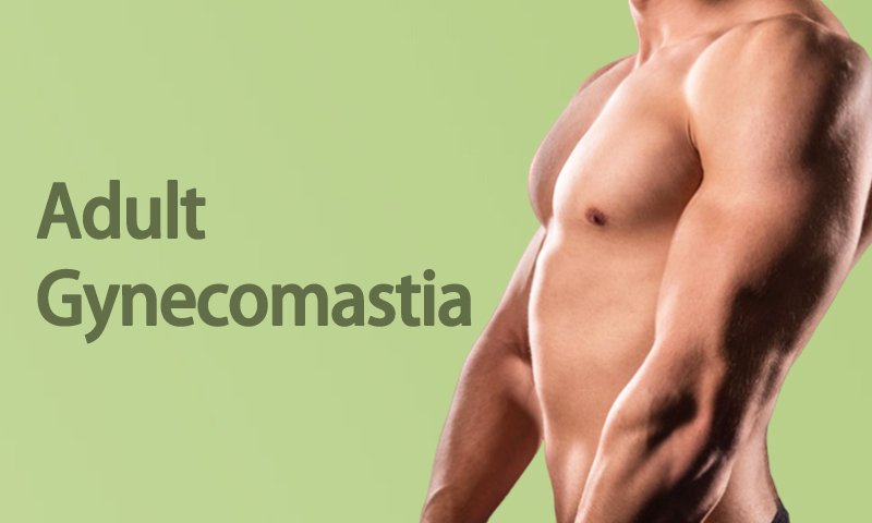 Adult Gynecomastia