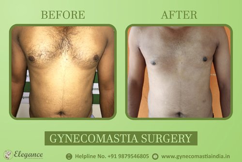 Adult Gynecomastia