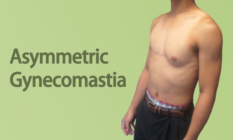 Asymmetric Gynecomastia