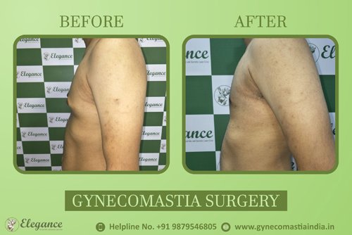 Asymmetric Gynecomastia