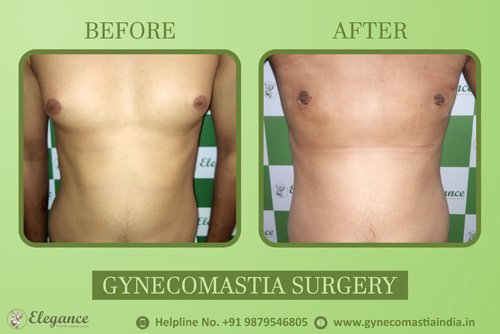 Asymmetric Gynecomastia