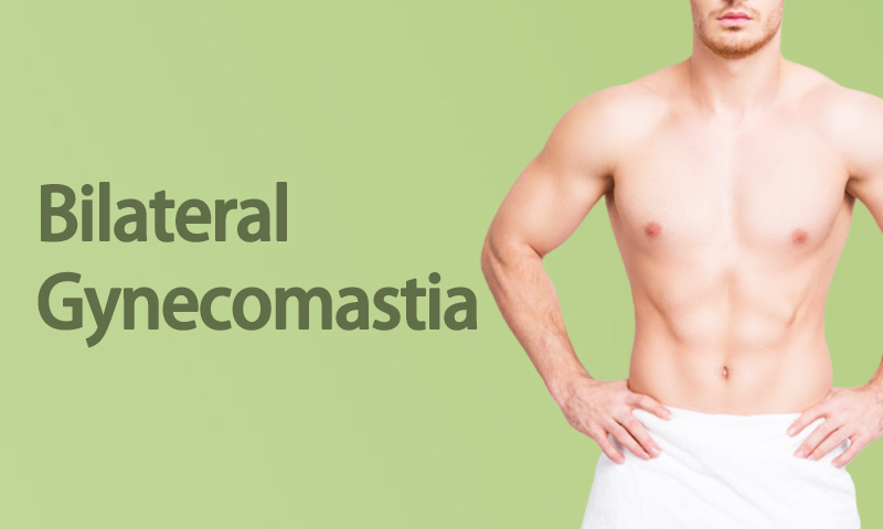 Bilateral Gynecomastia