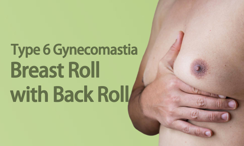 Type 6 Gynecomastia - Breast Roll with Back Roll