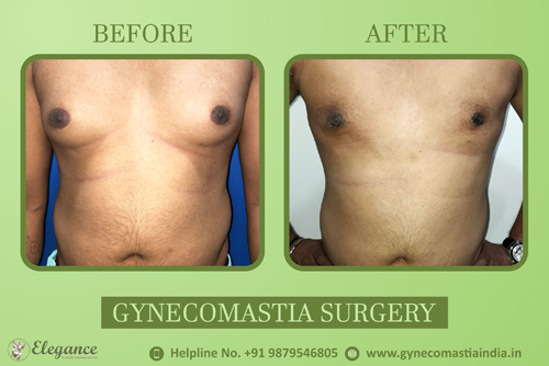 Male Nipple Reduction Gynecomastia