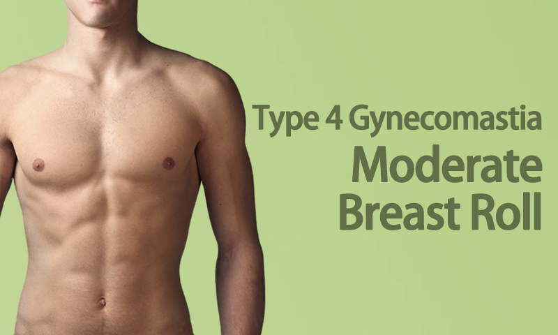 Type 4 Gynecomastia - Moderate Breast Roll