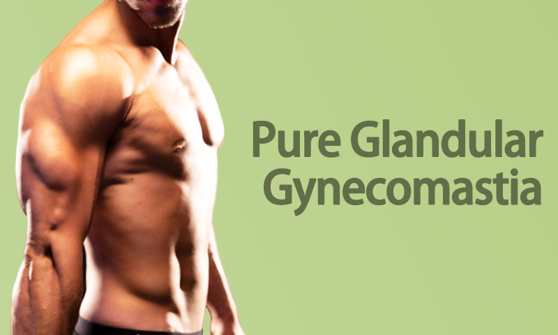 Pure Glandular Gynecomastia