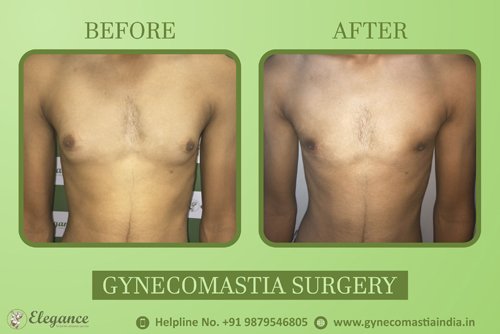 Pure Glandular Gynecomastia