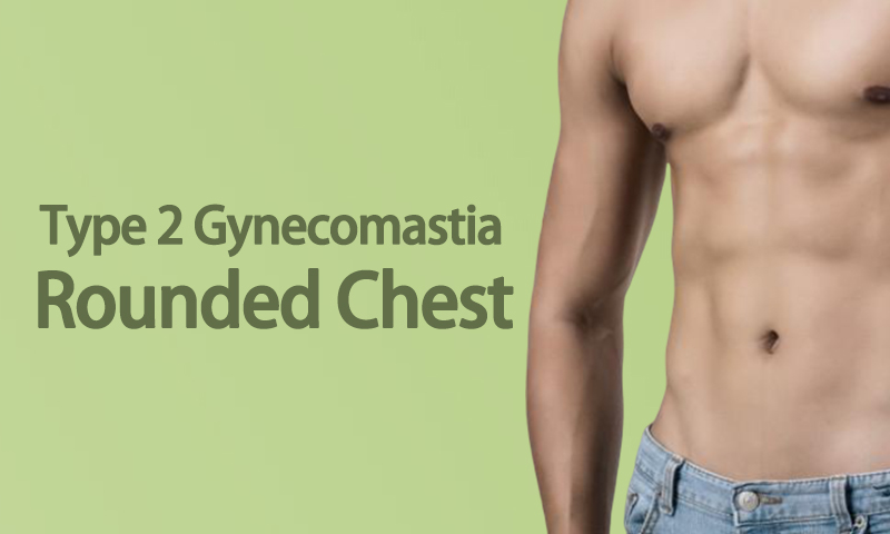 Type 2 Gynecomastia - Rounded Chest