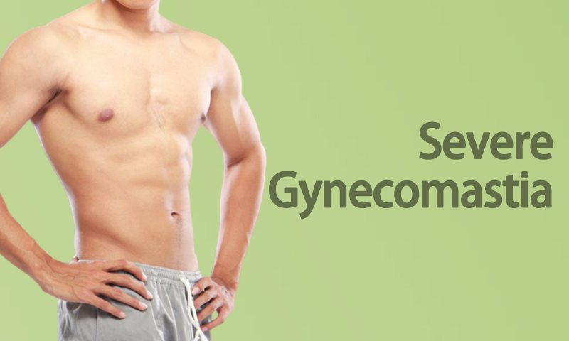 Severe Gynecomastia