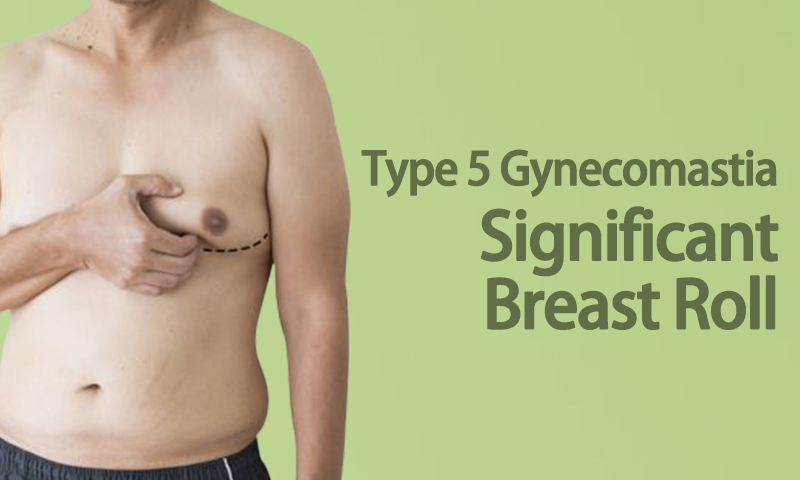 Type 5 Gynecomastia - Significant Breast Roll