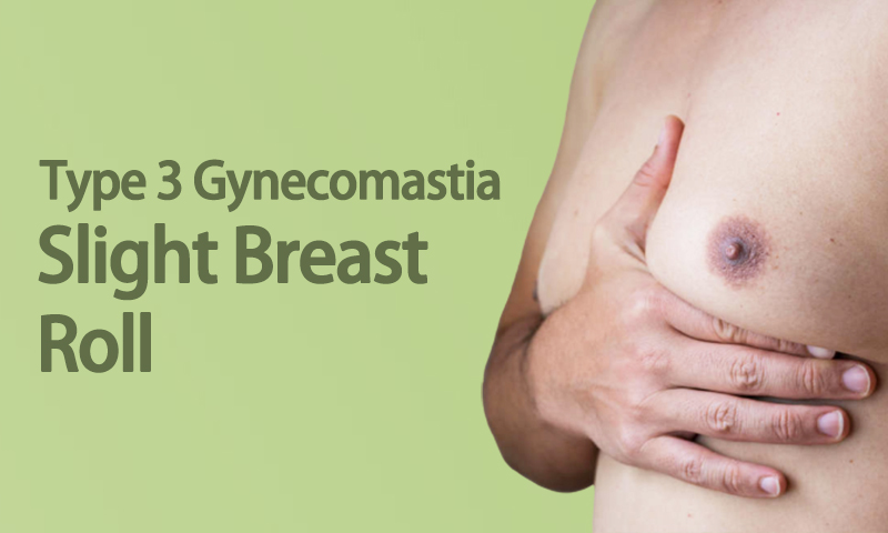 Type 3 Gynecomastia - Slight Breast Roll