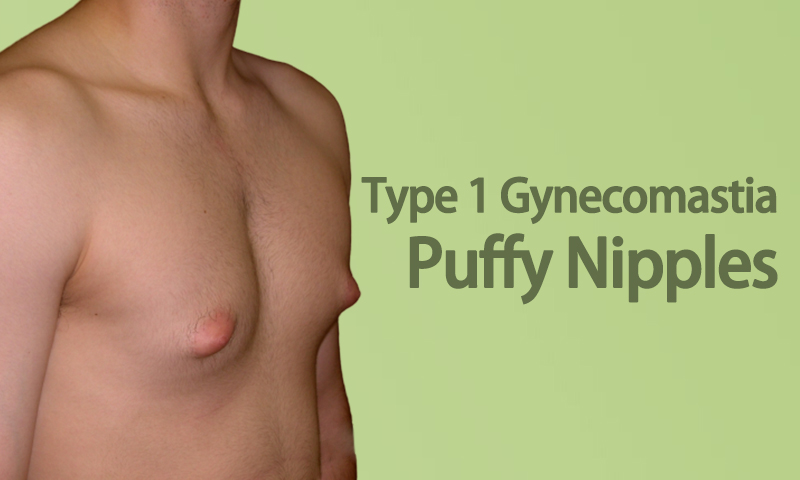 Type 1 Gynecomastia - Puffy Nipples in Surat