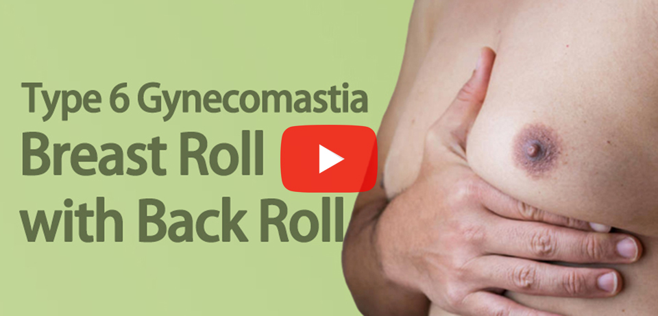 Type 6 Gynecomastia - Breast Roll with Back Roll