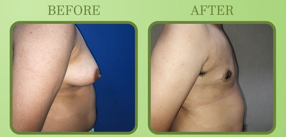 Type 6 Gynecomastia - Breast Roll with Back Roll