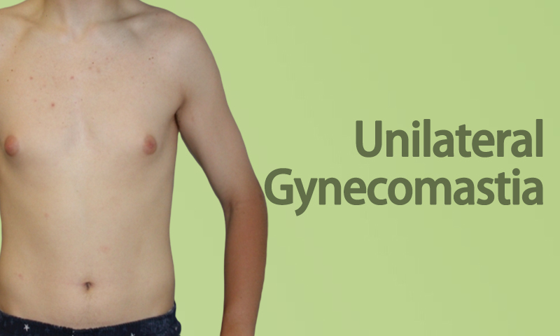 Unilateral Gynecomastia