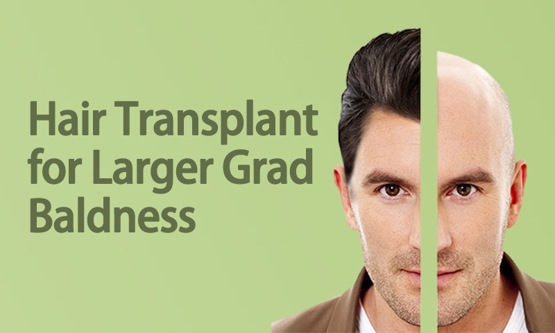 Hair Transplant For Larger Grad Baldness